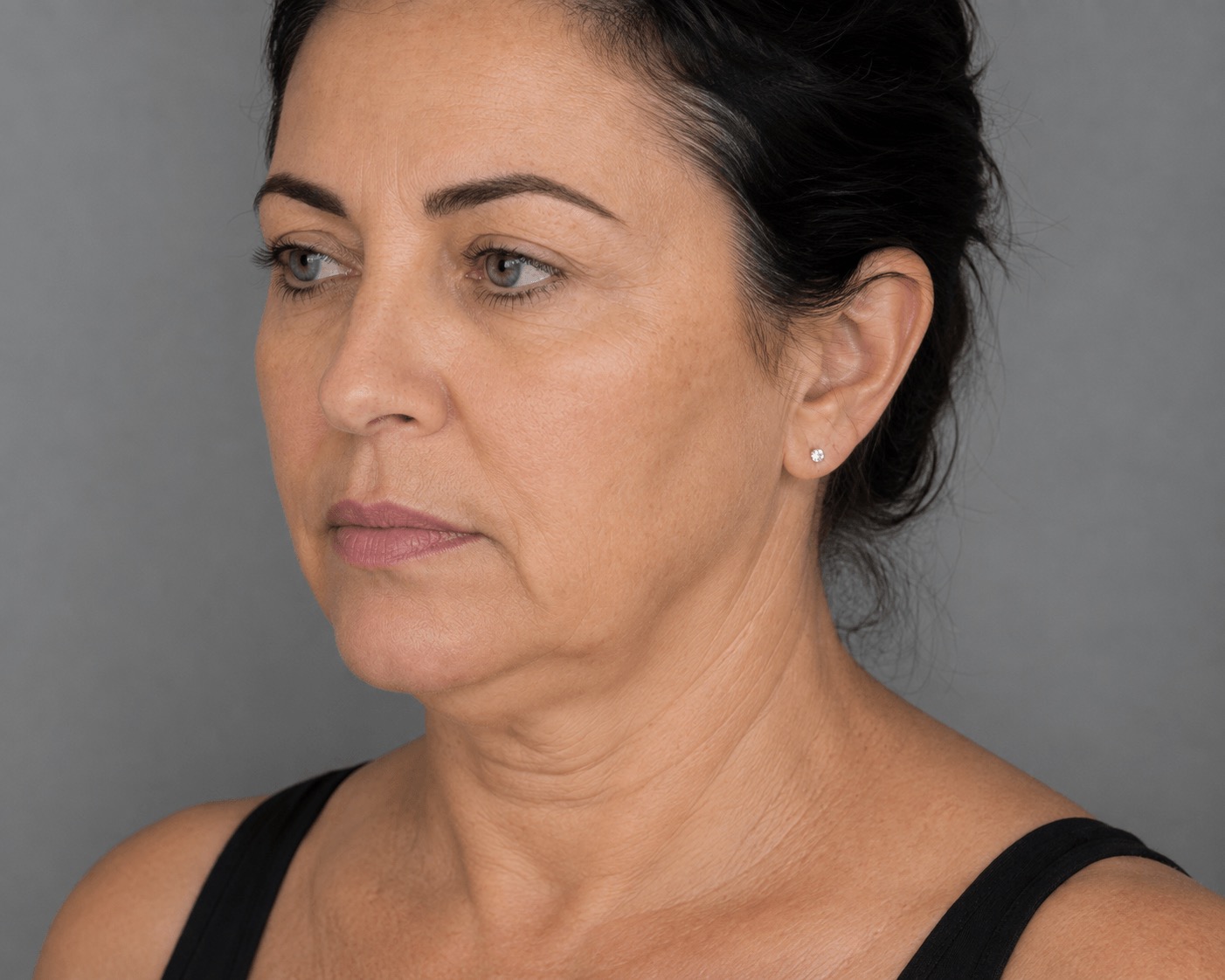 לפני טיפול Forma – עור רפוי וחוסר מיצוק באזור הפנים והצוואר