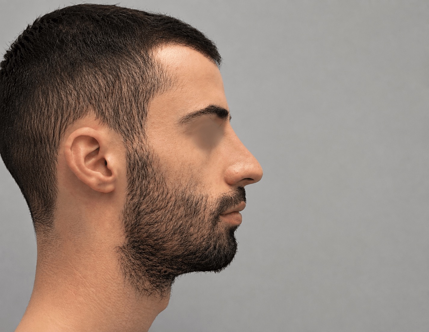 אף ישר והרמוני לאחר עיצוב ופיסול ללא ניתוח